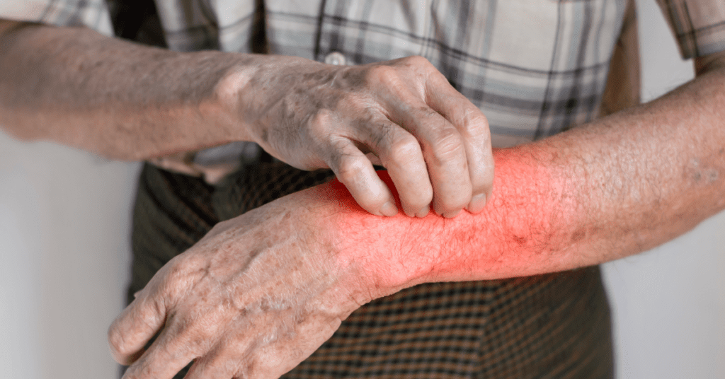 Ayurvedic Perspectives in Chronic Skin Disorders